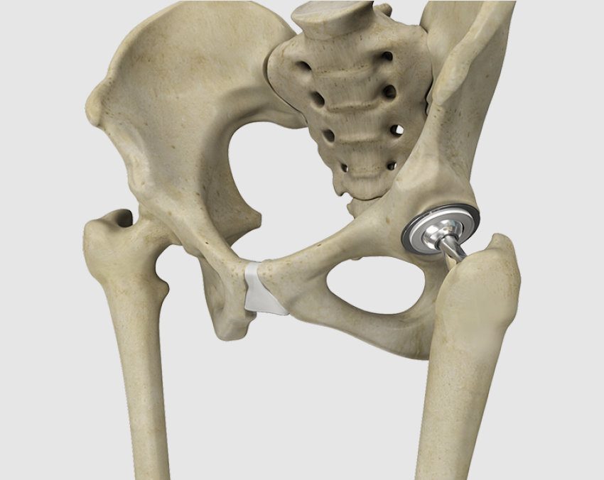 Hip And Pelvis Reconstruction Surgery In Dubai Dr Omar Sabri