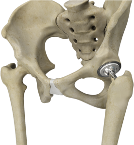 hip and pelvis reconstruction in dubai