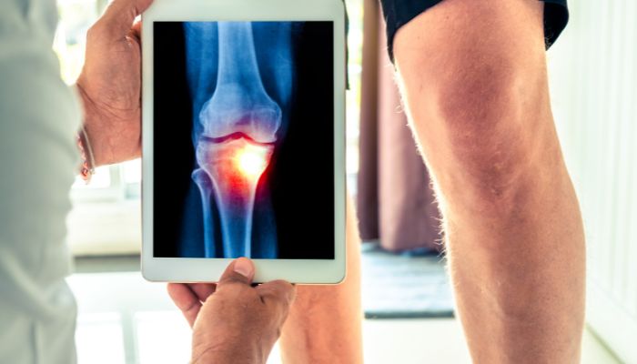 What is Osteoarthritis