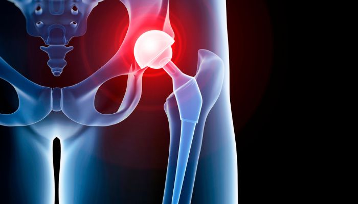Partial or Total Hip Replacement
