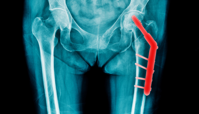 hip replacement surgery
